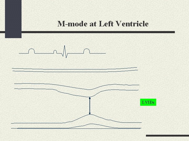 M-mode at Left Ventricle LVIDs 