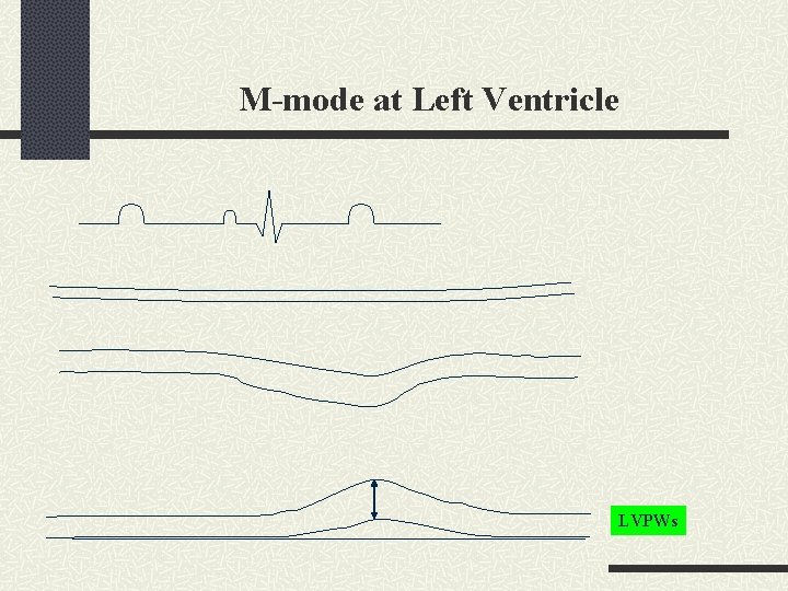 M-mode at Left Ventricle LVPWs 