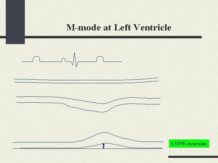 M-mode at Left Ventricle LVPW excursion 