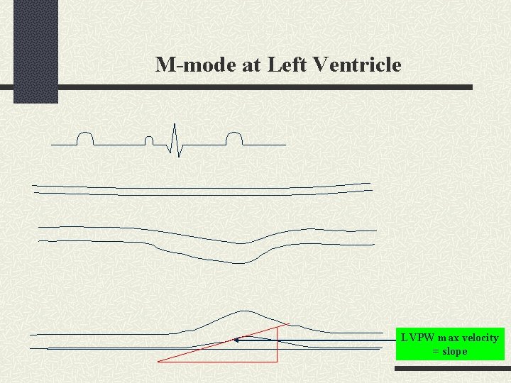 M-mode at Left Ventricle LVPW max velocity = slope 