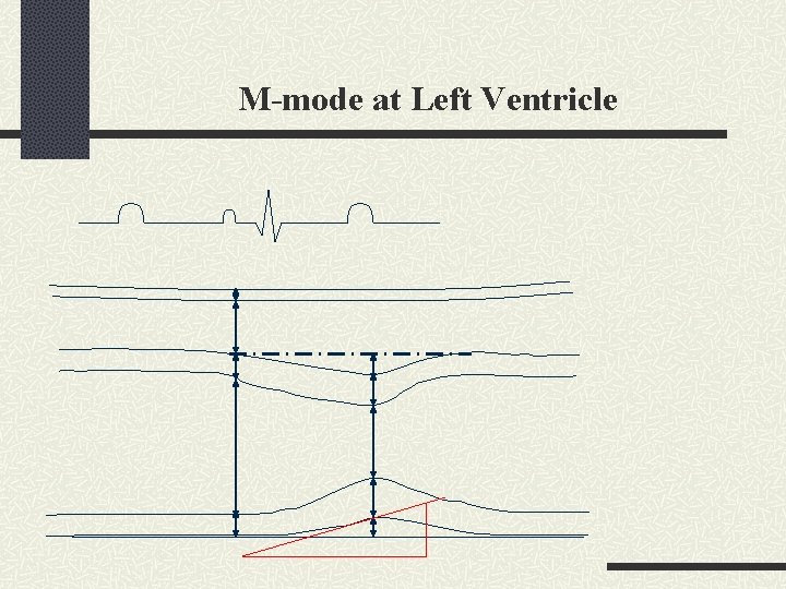 M-mode at Left Ventricle 