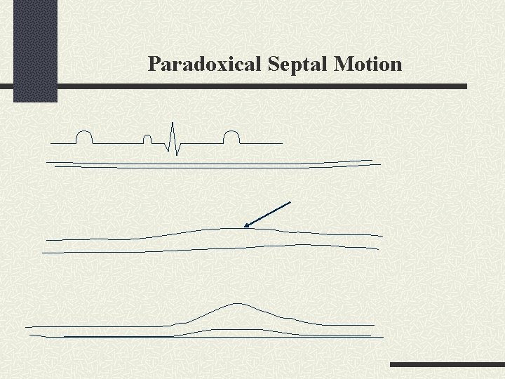 Paradoxical Septal Motion 