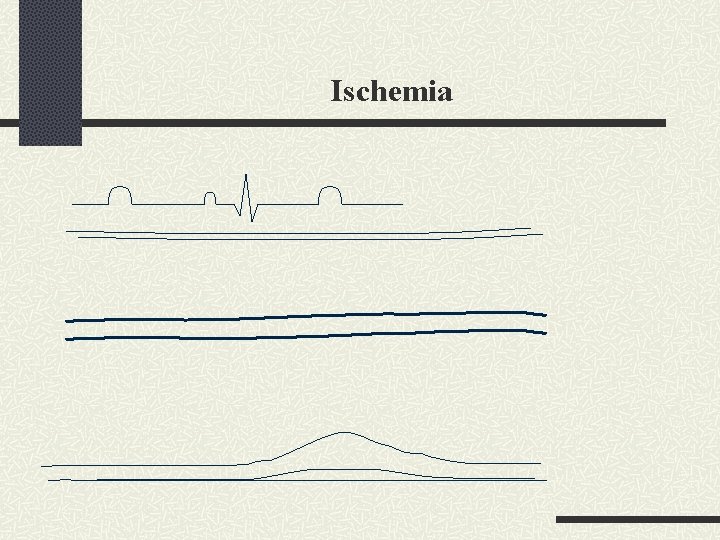 Ischemia 