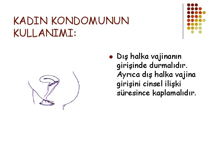 KADIN KONDOMUNUN KULLANIMI: l Dış halka vajinanın girişinde durmalıdır. Ayrıca dış halka vajina girişini