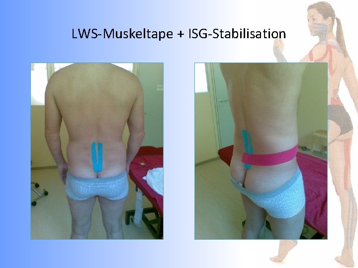 LWS-Muskeltape + ISG-Stabilisation 