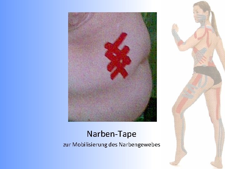 Narben-Tape zur Mobilisierung des Narbengewebes 