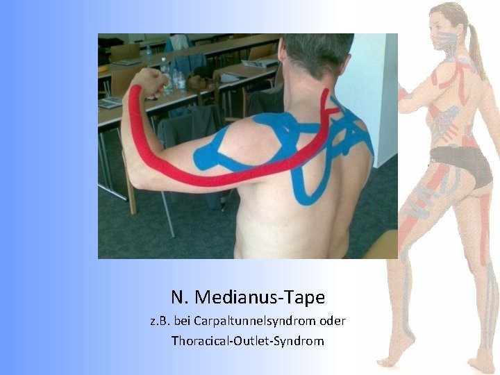 N. Medianus-Tape z. B. bei Carpaltunnelsyndrom oder Thoracical-Outlet-Syndrom 