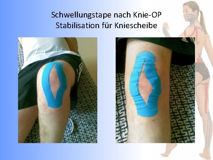 Schwellungstape nach Knie-OP Stabilisation für Kniescheibe 