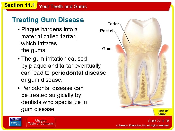 Section 14. 1 Your Teeth and Gums Treating Gum Disease Tartar • Plaque hardens