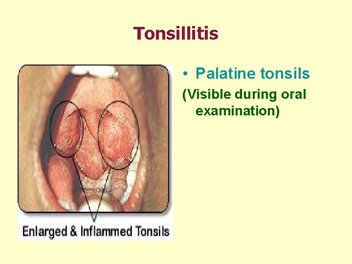 Tonsillitis • Palatine tonsils (Visible during oral examination) 