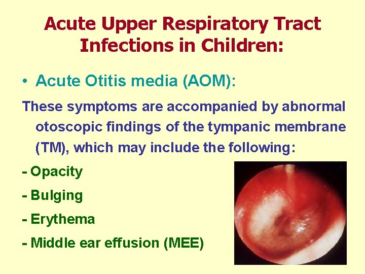 Acute Upper Respiratory Tract Infections in Children: • Acute Otitis media (AOM): These symptoms