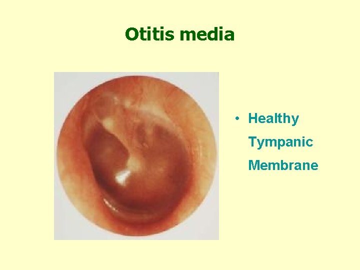 Otitis media • Healthy Tympanic Membrane 