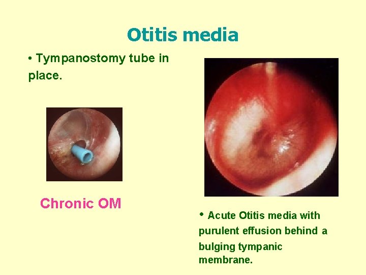 Otitis media • Tympanostomy tube in place. Chronic OM • Acute Otitis media with