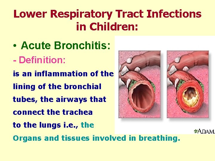 Lower Respiratory Tract Infections in Children: • Acute Bronchitis: - Definition: is an inflammation