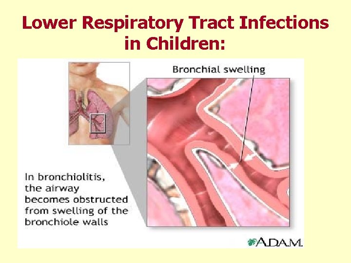 Lower Respiratory Tract Infections in Children: 