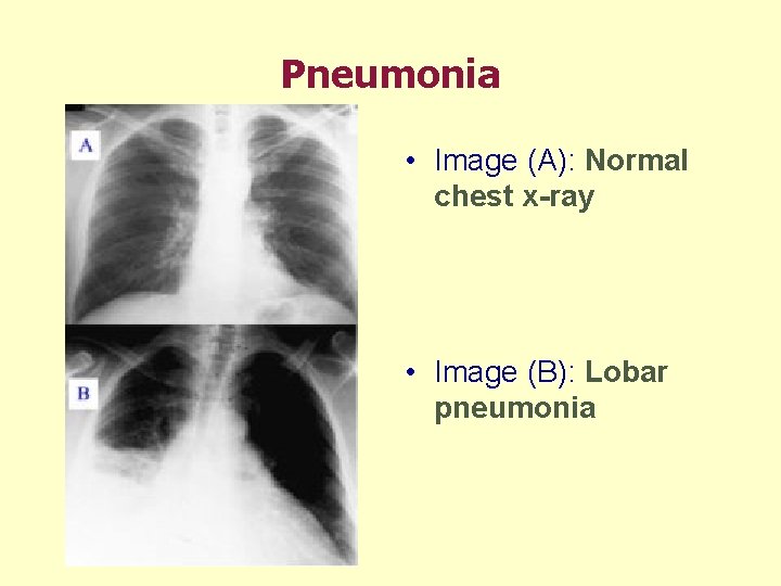 Pneumonia • Image (A): Normal chest x-ray • Image (B): Lobar pneumonia 