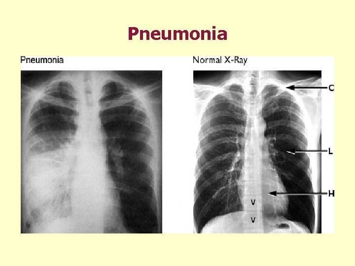 Pneumonia 