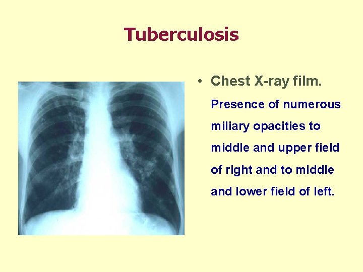 Tuberculosis • Chest X-ray film. Presence of numerous miliary opacities to middle and upper