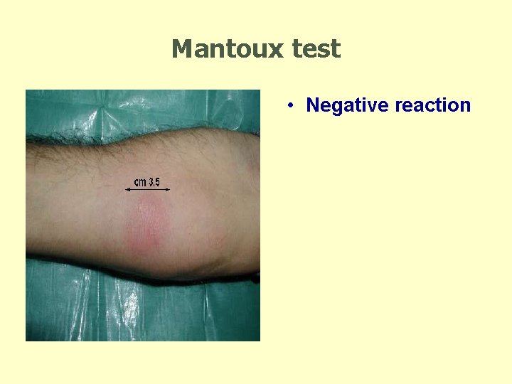 Mantoux test • Negative reaction 