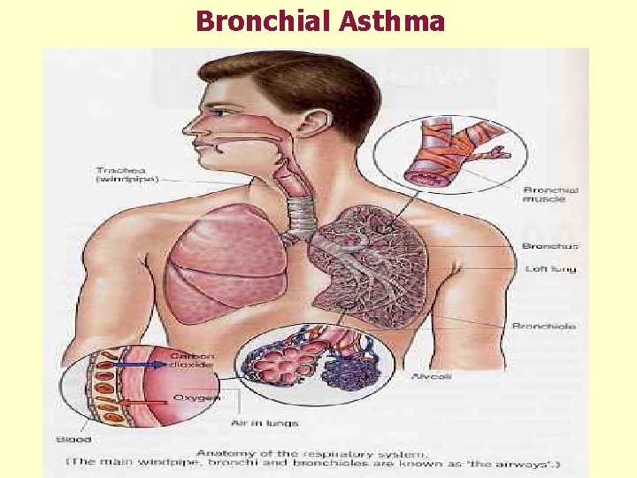 Bronchial Asthma 