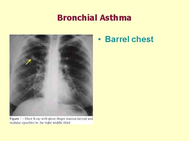 Bronchial Asthma • Barrel chest 