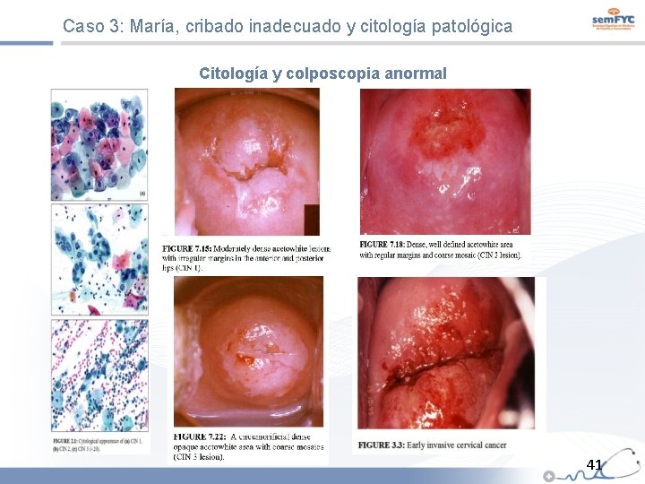 Caso 3: María, cribado inadecuado y citología patológica Citología y colposcopia anormal 41 