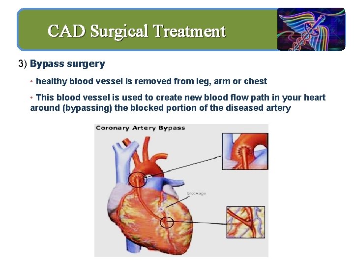 CAD Surgical Treatment 3) Bypass surgery • healthy blood vessel is removed from leg,