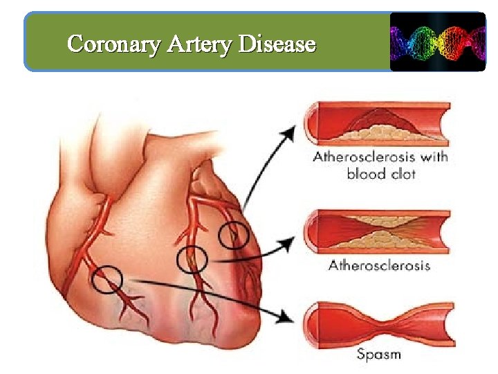 Coronary Artery Disease 