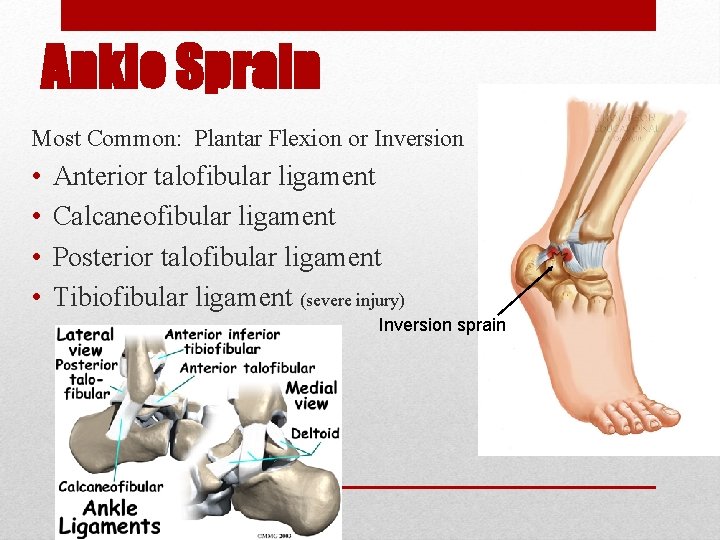Ankle Sprain Most Common: Plantar Flexion or Inversion • • Anterior talofibular ligament Calcaneofibular