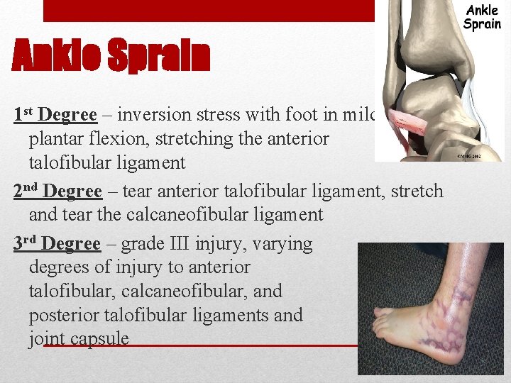 Ankle Sprain 1 st Degree – inversion stress with foot in mild plantar flexion,