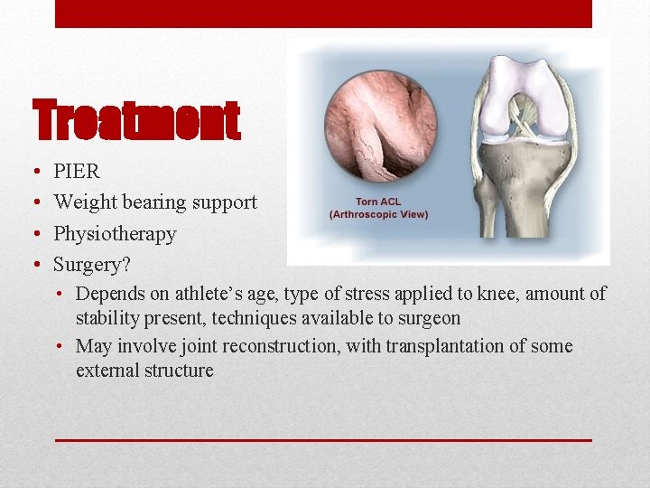 Treatment • • PIER Weight bearing support Physiotherapy Surgery? • Depends on athlete’s age,
