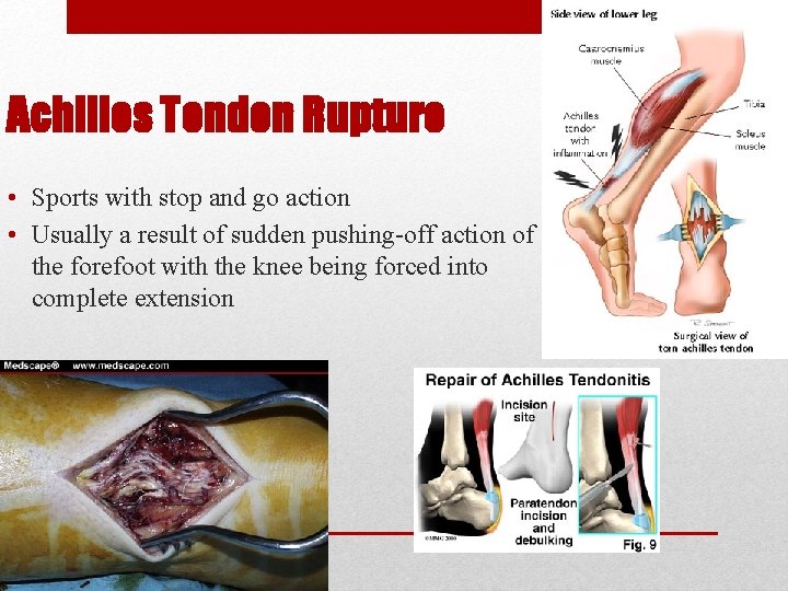 Achilles Tendon Rupture • Sports with stop and go action • Usually a result