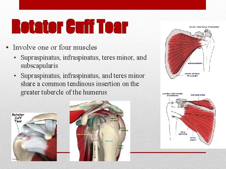 Rotator Cuff Tear • Involve one or four muscles • Supraspinatus, infraspinatus, teres minor,