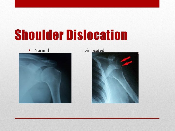 Shoulder Dislocation • Normal Dislocated 