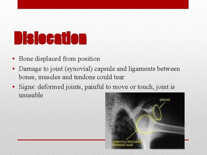 Dislocation • Bone displaced from position • Damage to joint (synovial) capsule and ligaments