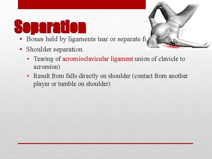 Separation • Bones held by ligaments tear or separate from each other • Shoulder