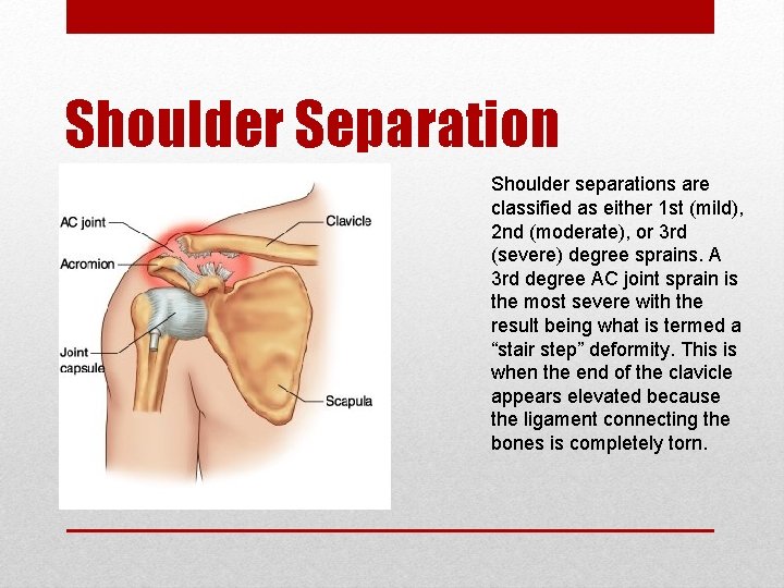 Shoulder Separation Shoulder separations are classified as either 1 st (mild), 2 nd (moderate),