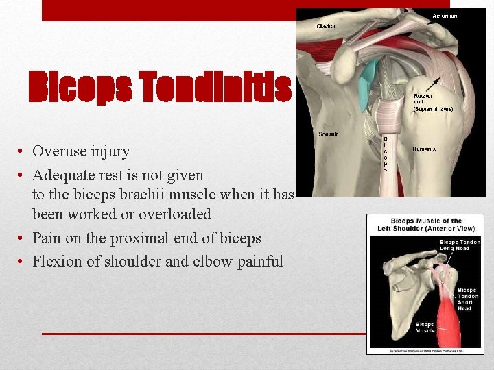 Biceps Tendinitis • Overuse injury • Adequate rest is not given to the biceps