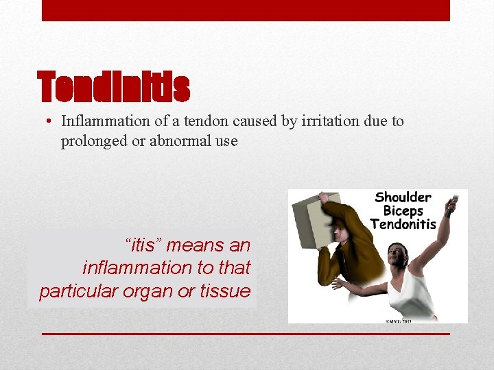 Tendinitis • Inflammation of a tendon caused by irritation due to prolonged or abnormal