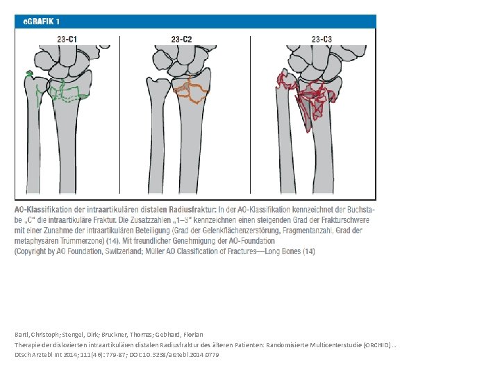 Bartl, Christoph; Stengel, Dirk; Bruckner, Thomas; Gebhard, Florian Therapie der dislozierten intraartikulären distalen Radiusfraktur