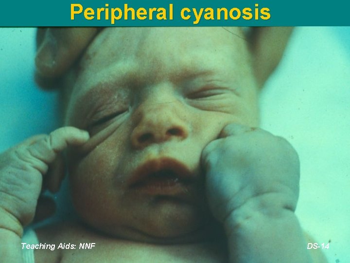 Peripheral cyanosis Teaching Aids: NNF DS-14 