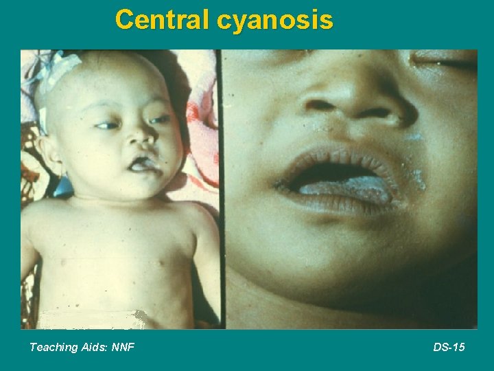 Central cyanosis Teaching Aids: NNF DS-15 