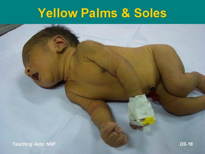 Yellow Palms & Soles Teaching Aids: NNF DS-16 