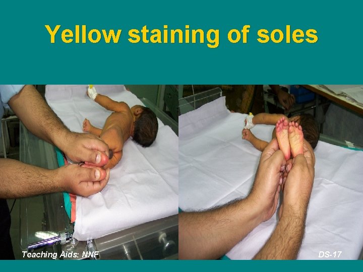 Yellow staining of soles Teaching Aids: NNF DS-17 