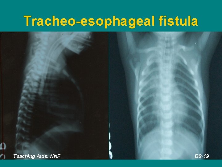 Tracheo-esophageal fistula Teaching Aids: NNF DS-19 
