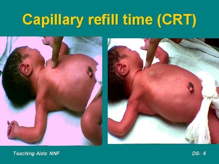 Capillary refill time (CRT) Teaching Aids: NNF DS- 6 