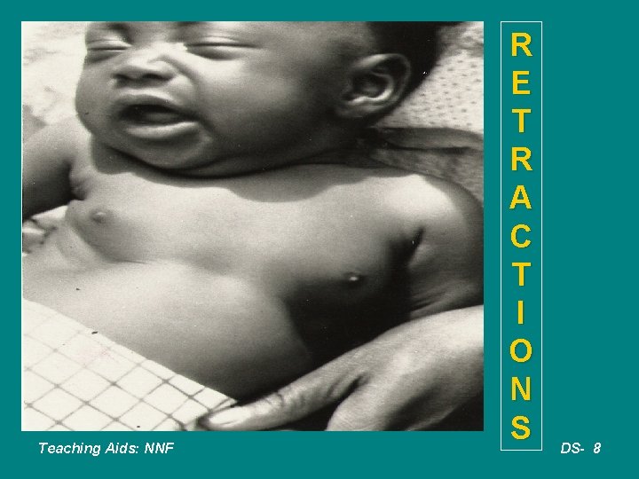 Teaching Aids: NNF R E T R A C T I O N S