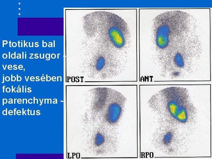 Ptotikus bal oldali zsugor vese, jobb vesében fokális parenchyma defektus 