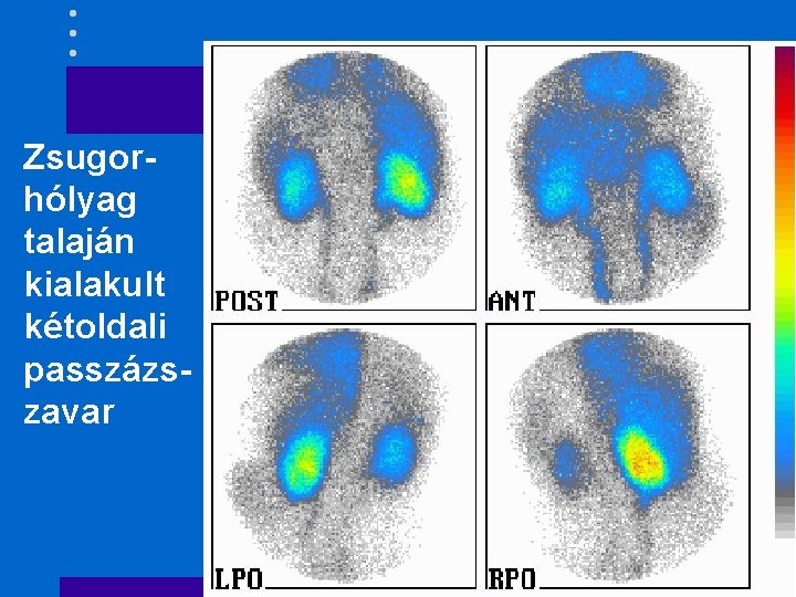 Zsugorhólyag talaján kialakult kétoldali passzázszavar 
