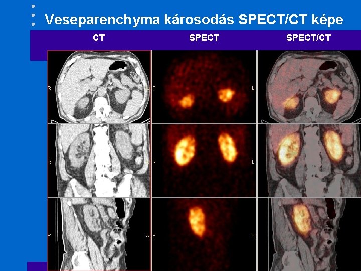 Veseparenchyma károsodás SPECT/CT képe CT SPECT/CT 
